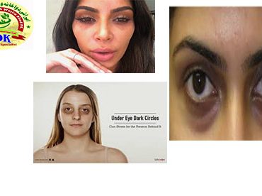 iranidawakhana-natural-tips-female-tips-dark-circles-under-the-eyes
