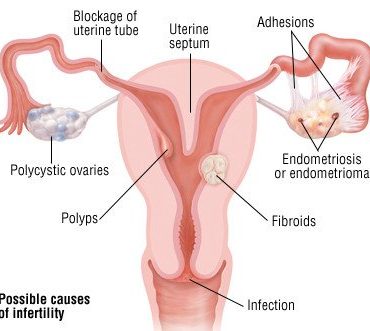 iranidawakhana-treatment-female-treatment-female-infertility