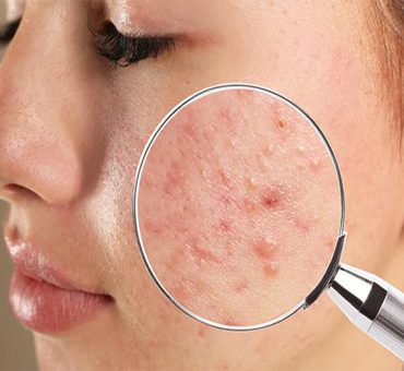 iranidawakhana-treatment-general-treatment-acne