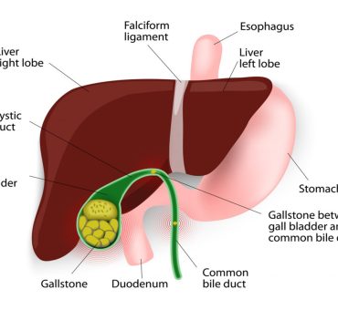 iranidawakhana-treatment-general-treatment-gall-bladder-stone