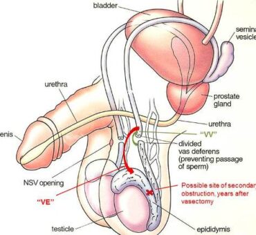 iranidawakhana-treatment-male-treatment-male-infertility-damaged-sperm-ducts